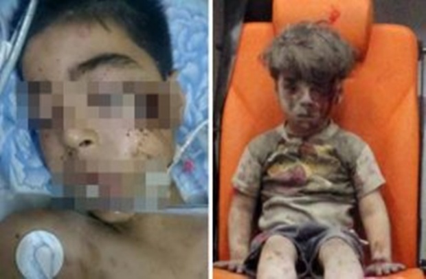 เศร้า !! เด็กน้อยวัย 5 ขวบชาวซีเรียที่โดนระเบิดไลล่าสุดต้องรับข่าวร้ายพี่ชายจากไป