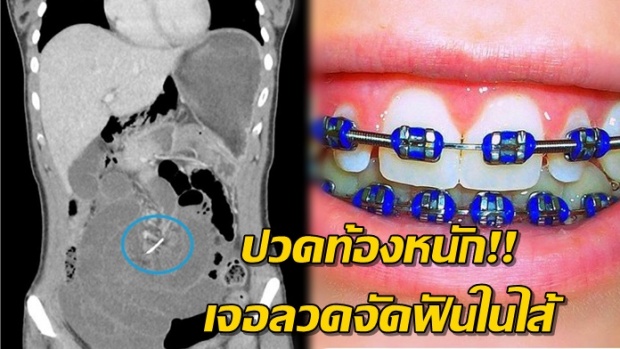 สาวปวดท้องหนักมาหาหมอ สแกนเจอลวดจัดฟันในลำไส้ พบอยู่ในท้องมานับ 10 ปี