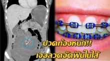 สาวปวดท้องหนักมาหาหมอ สแกนเจอลวดจัดฟันในลำไส้ พบอยู่ในท้องมานับ 10 ปี