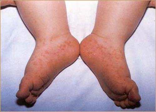 กทม.เฝ้าระวังโรคมือ เท้า ปาก-ยันเชื้อโรคในไทยไม่อันตรายถึงชีวิต 