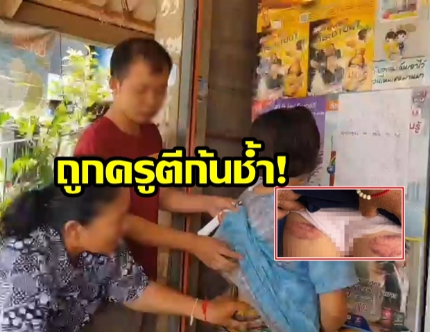 อีกแล้วหรือ!? นร.หญิงป.5 ถูกครูตีจนก้นช้ำ เพราะทำเวรไม่สะอาด