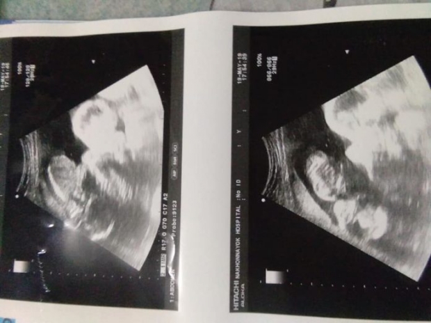 หมอชี้เด็กแท้งแล้ว! ไล่สาวท้องแฝด 5 เดือนแท้งใส่ชักโครก “ทั้งที่ลูกยังดิ้น”