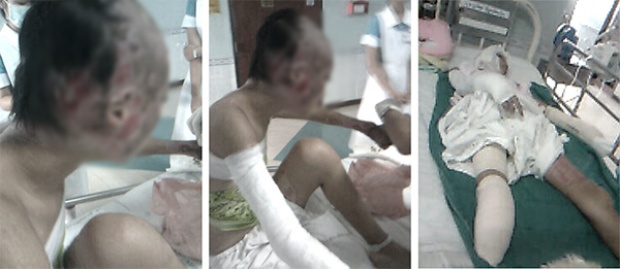 สาวประสบอุบัติถูกรถสิบล้อฝ่าไฟแดงลาก ต้องตัดมือ นิ้ว หู และขา สุดท้ายรอดมาได้ เพราะในหลวง ร.9