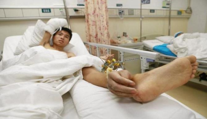 สุดทึ่ง! แพทย์ท้องถิ่นจีน ผ่าตัดต่อมือขาดนับเดือน