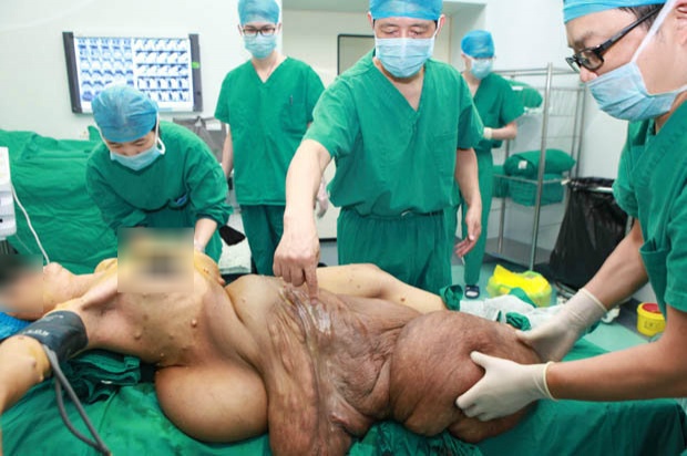 หมอจีนเจ๋ง!! ผ่าตัดเนื้องอกยักษ์ หนัก 25กก.สำเร็จ!