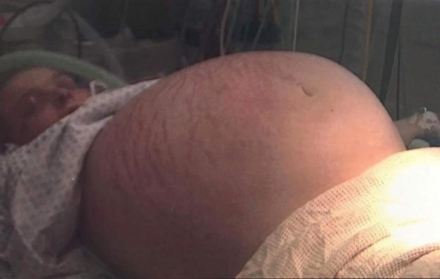 เผยสาเหตุ สาวท้องป่องมหึมา ขนาดหมอยังนึกว่าตั้งครรภ์!!