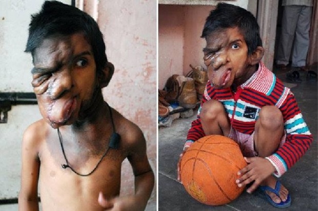 เด็กชายอินเดียวัย 7 ขวบป่วยเนื้องอก ลุกลามจนใบหน้าเละ-ตาบอด