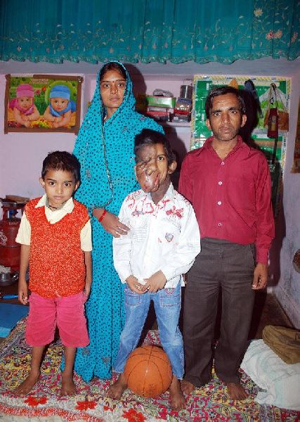 เด็กชายอินเดียวัย 7 ขวบป่วยเนื้องอก ลุกลามจนใบหน้าเละ-ตาบอด