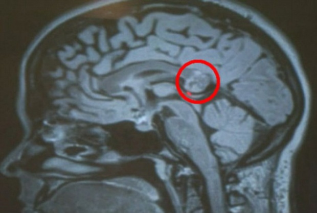 สุดสยอง! หมอพบตัวอ่อนของมนุษย์ในสมองนักศึกษาสาว