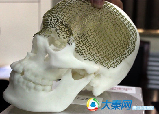 แพทย์จีนรักษาคนไข้กะโหลกยุบด้วยเครื่องปรินเตอร์ 3D