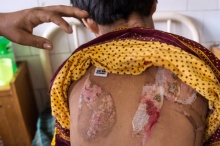 สลด!! เด็กหญิงพม่าเผย “มันเจ็บ” ถูกนายจ้างทารุณเตารีดนาบ-น้ำร้อนลวกตัว