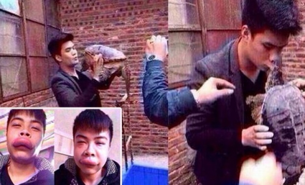 ภาพล่าสุด! หนุ่มจีนถูกเต่างับปากเจ่อ หลังขอจูบสุดท้าย