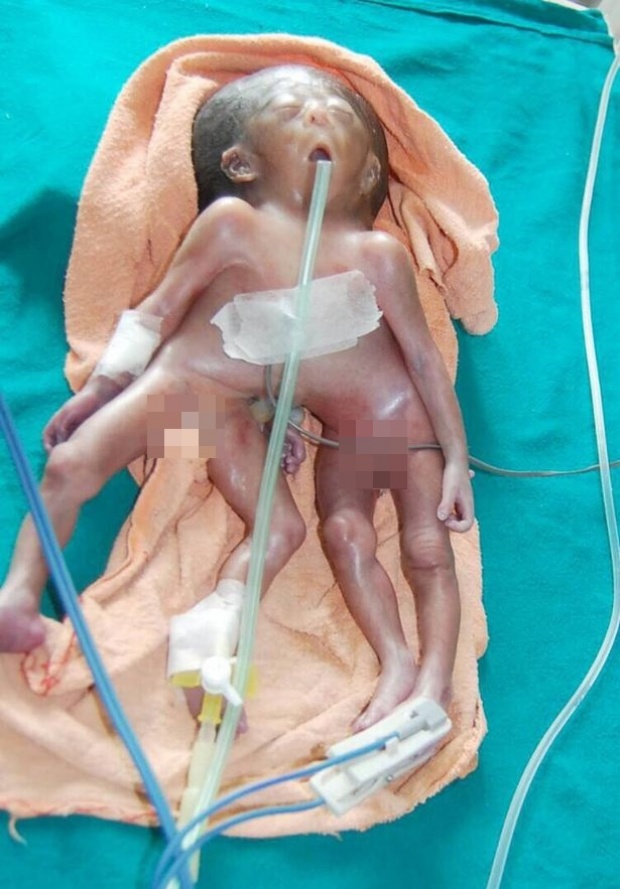 เด็กประหลาด! ทารกแรกเกิด 2 ลำตัว 4 แขน 4 ขา แพทย์ชี้เป็นโรคหายาก! (คลิป)