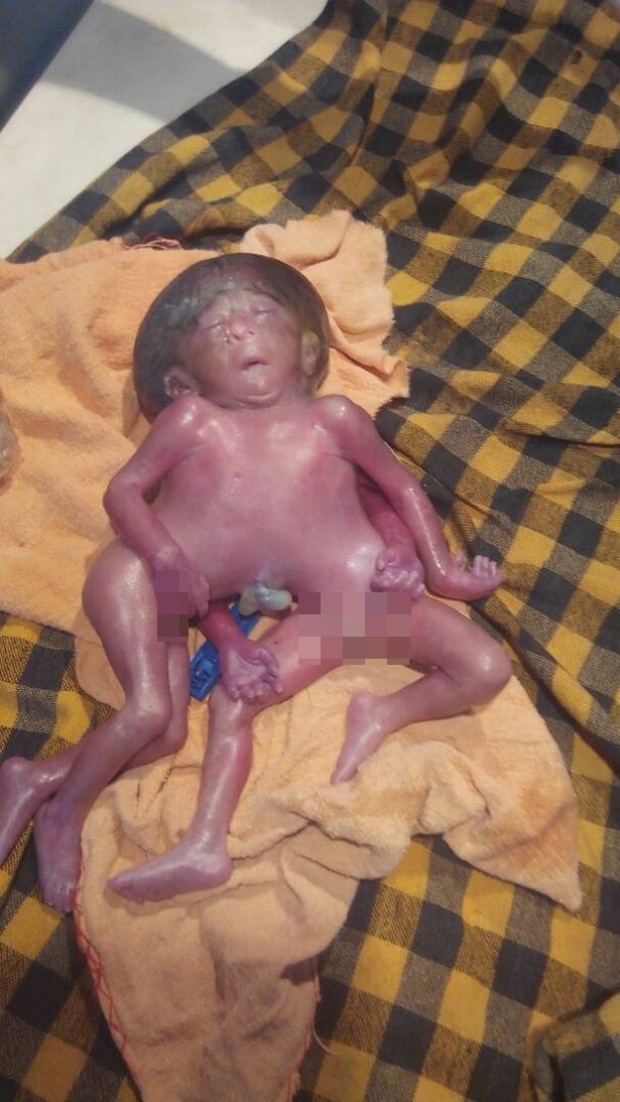 เด็กประหลาด! ทารกแรกเกิด 2 ลำตัว 4 แขน 4 ขา แพทย์ชี้เป็นโรคหายาก! (คลิป)