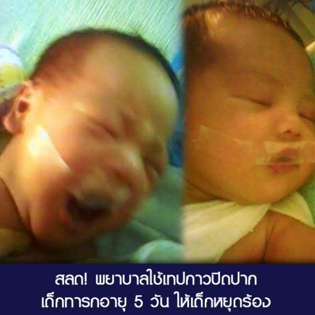 สลด! พยาบาลใช้เทปปิดปากเด็กทารกอายุ 5 วัน ให้เด็กหยุดร้อง