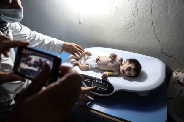 ภาพสลดสะเทือนใจ..ทารกในสมรภูมิซีเรียผอมแกรน สะท้อนภาวะขาดสารอาหาร
