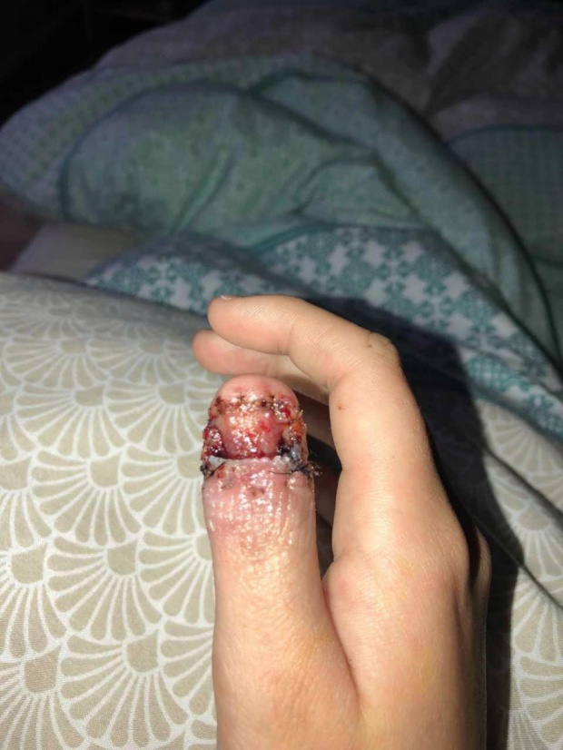 หญิงสาวกัดเล็บมือจนเกลี้ยง ลุกลามจนกลายเป็นมะเร็งผิวหนัง สุดท้ายต้องตัดนิ้วโป้งทิ้ง!!