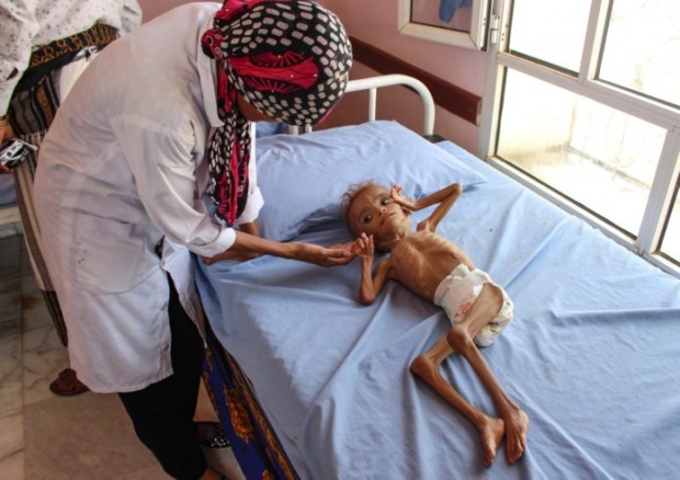 สุดสลด!! สงครามเยเมนทำข้าวของแพง เด็ก 5 ล้านคน ประสบภาวะอดอาหาร