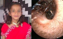 สาวน้อยวัย 12 ปี มีมดคลานออกมาจากหูมากถึง 1,000 ตัว ทุกวัน!! แถมคีบเท่าไหร่ก็ไม่หมด (มีคลิป)