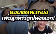 สู้ไปกับลูก! พ่อยอมตัดผิวหนัง ยื้อชีวิตลูกสาวถูกไฟคลอก (คลิป)