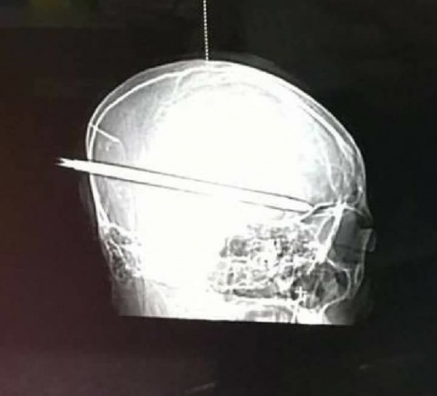  สุดสยอง!! เผยภาพเอ็กซเรย์กะโหลก น้องปอนด์ โจ๋เหี้ยมใช้ไขควงแทงศีรษะ-ทะลุก้านสมอง!