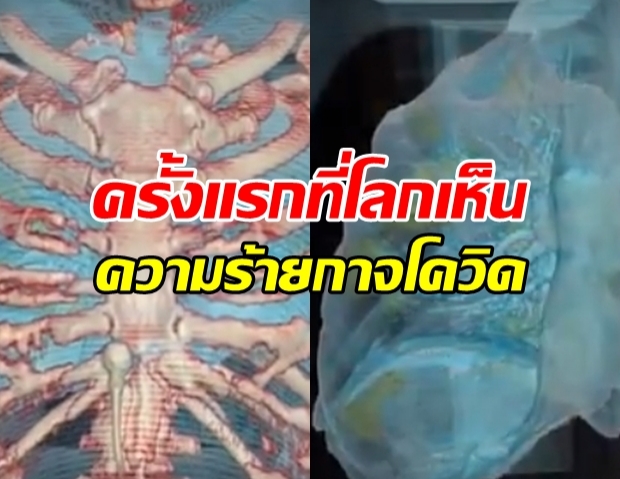 เปิดเผยครั้งแรก! ปอดขณะถูกทำลายจาก โควิด-19 แบบ 3D (มีคลิป)