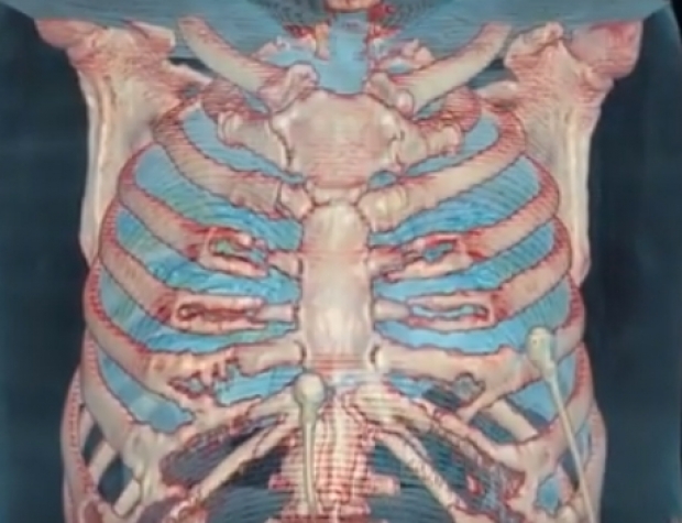 เปิดเผยครั้งแรก! ปอดขณะถูกทำลายจาก โควิด-19 แบบ 3D (มีคลิป)