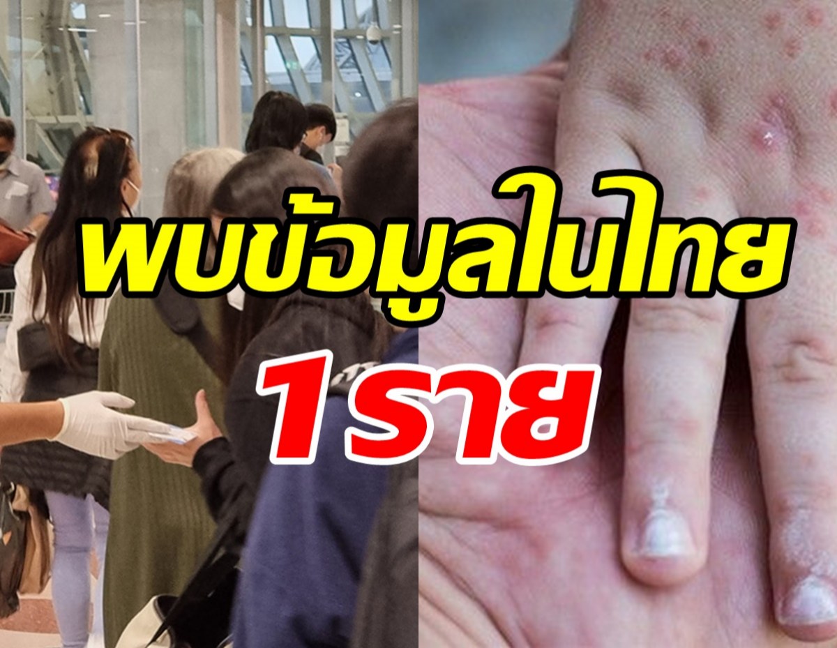 ระทึก! สธ.รายงานมีผู้ป่วยฝีดาษลิงเดินทางพักเครื่องในไทย