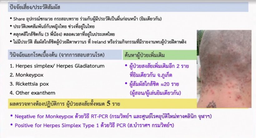 ระทึก! สธ.รายงานมีผู้ป่วยฝีดาษลิงเดินทางพักเครื่องในไทย