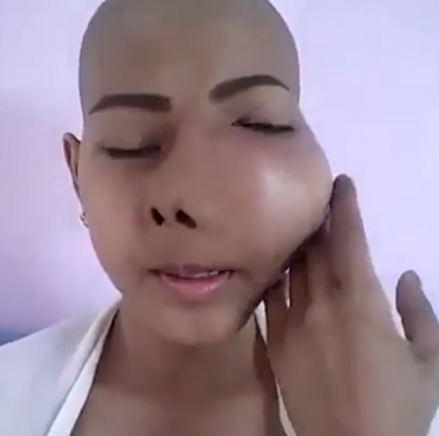 สงสาร! สาวป่วยแก้มบวมจากพิษมะเร็ง อ้อนวอนหมอฝีมือดีช่วยรักษา