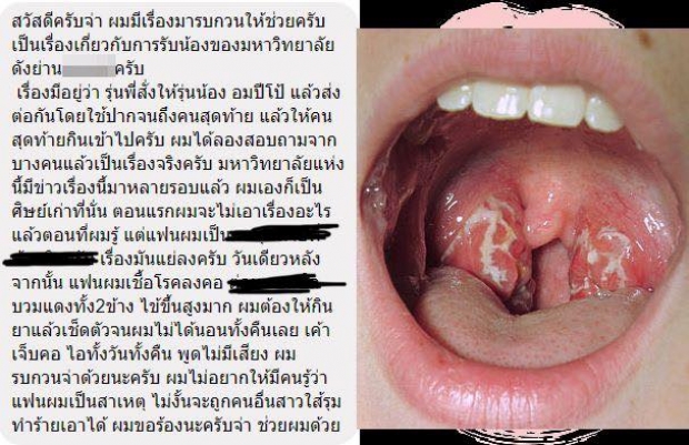 รับน้อง ม.ดัง ให้อมปีโป้ต่อกัน คนสุดท้ายให้กลืน สุดท้ายเชื้อโรคลงคอ เป็นทอนซิลอักเสบ