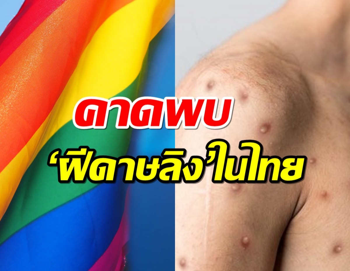 เอาแล้ว!สธ.คาดพบ ‘ฝีดาษลิง’ในไทย สัปดาห์หน้า!