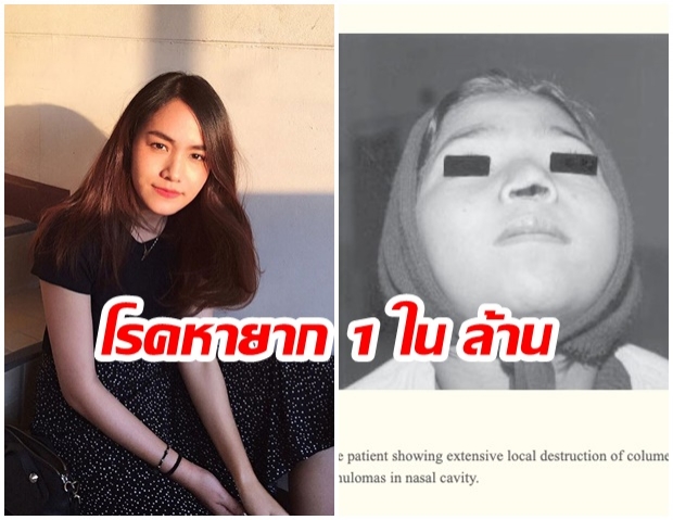 ทำไม? “วัณโรคหลังโพรงจมูก” ถึงเป็นโรคหายาก 1 ในล้าน