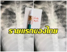 พบผู้ป่วยไทยรายแรก ปอดอักเสบ หลังสูบสารกัญชาด้วยบุหรี่ไฟฟ้า