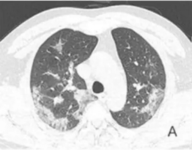 ตะลึงทั้งโลก!?! เปิดภาพ X-ray ปอดผู้เสียชีวิต COVID-19