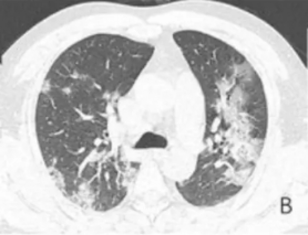 ตะลึงทั้งโลก!?! เปิดภาพ X-ray ปอดผู้เสียชีวิต COVID-19