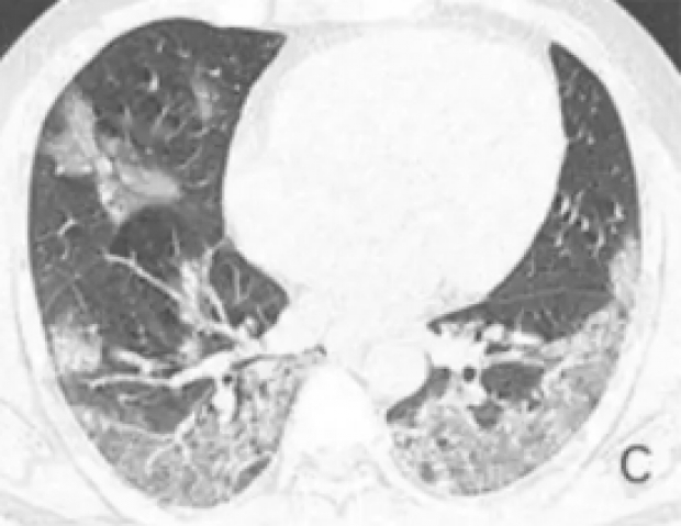 ตะลึงทั้งโลก!?! เปิดภาพ X-ray ปอดผู้เสียชีวิต COVID-19