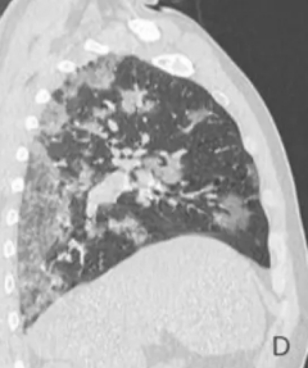 ตะลึงทั้งโลก!?! เปิดภาพ X-ray ปอดผู้เสียชีวิต COVID-19