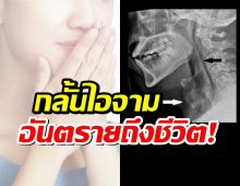 กลั้นไอจาม เสี่ยงอันตรายถึงชีวิต! ภัยเงียบที่หลายคนมองข้าม