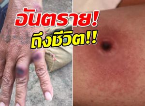 เช็คอาการ แอนแทรกซ์ โรคติดต่อจากสัตว์ ที่ไทยพบผู้เสียชีวิตเเล้ว
