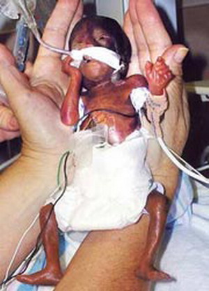 มหัศจรรย์ทารกจิ๋วสุดในโลกมีชีวิตรอดปาฏิหาริย์ 