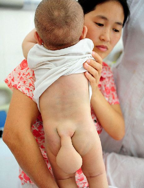 รัดทด! แม่วอนแพทย์ช่วยลูก เกิดมามีหาง หมอส่ายหัวบอกยาก(ชมภาพ) 