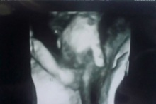 อัลตร้าซาวด์เผยทารกแฝดจับมือกันแน่นขณะเสี่ยงเสียชีวิตในครรภ์มารดา