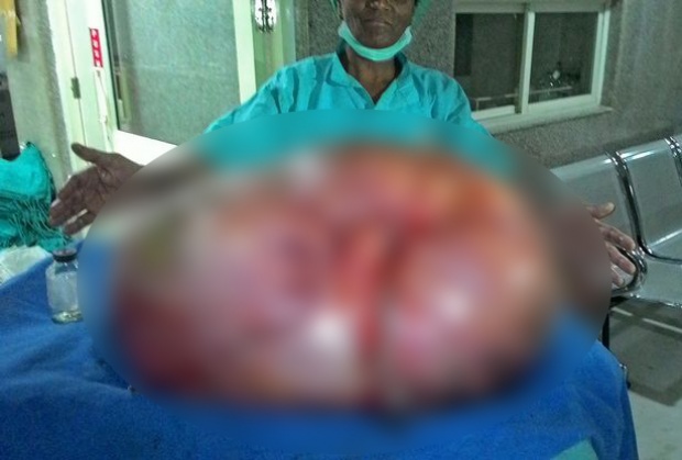 แพทย์ตะลึง!!ผ่าเนื้องอก 95 กิโลกรัม ท้องหญิงชาวอินเดีย