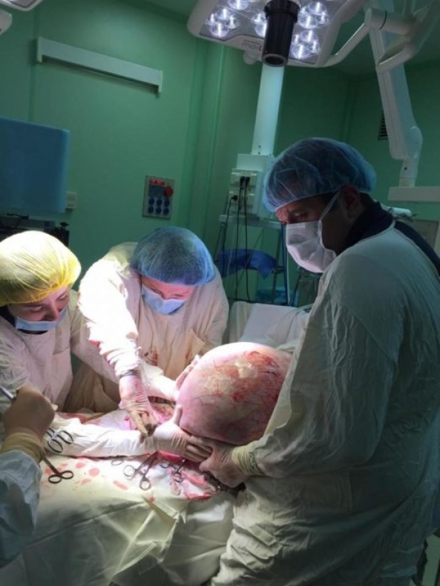 หมอผ่าตัดตะลึงสุดๆ หญิงวัยกลางคนมี “เนื้องอกรังไข่” 25 กิโลกรัม