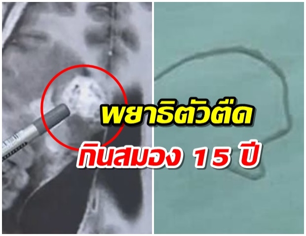 ผ่าออก “พยาธิตัวตืด” ยาว 12 ซม. เปิบเนื้อสมอง อยู่ในหัวคนนาน 15 ปี