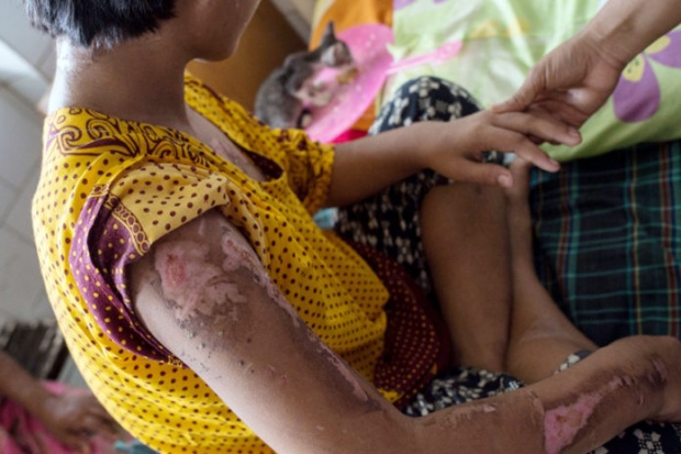 สลด!! เด็กหญิงพม่าเผย “มันเจ็บ” ถูกนายจ้างทารุณเตารีดนาบ-น้ำร้อนลวกตัว