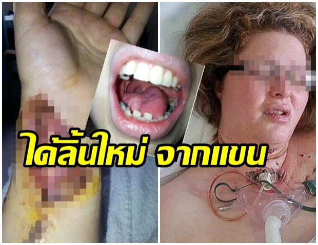 หญิงสูบบุหรี่-ป่วยมะเร็ง ได้ “ลิ้น” ใหม่ หมอปลูกถ่ายจาก “แขน” คนไข้