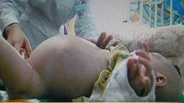 ช็อกโลกเด็กชายสองขวบคลอดลูกแฝด หลังเกิดตัวอ่อนในท้อง 