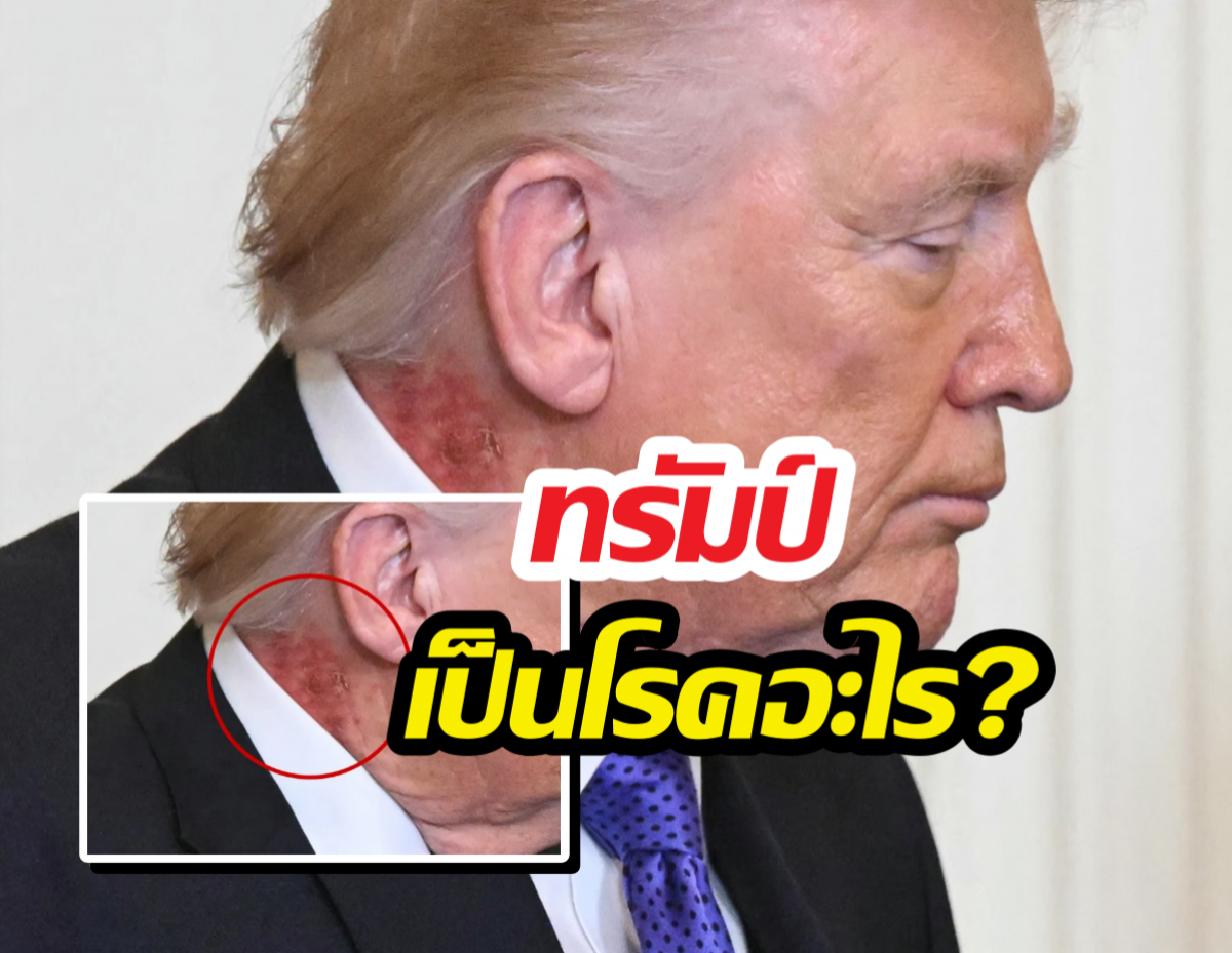 โซเชียลแห่แชร์ ทรัมป์เป็นโรคอะไร?มีแผลผื่นแดงหนารอบลำคอ